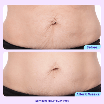 VELORA - Tighten & Smooth Belly Cream